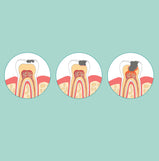 Decayed Teeth Test Paper